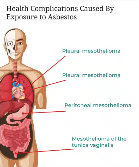 A diagram showing the health complications caused from asbestos exposure detailing the different type of mesothelioma