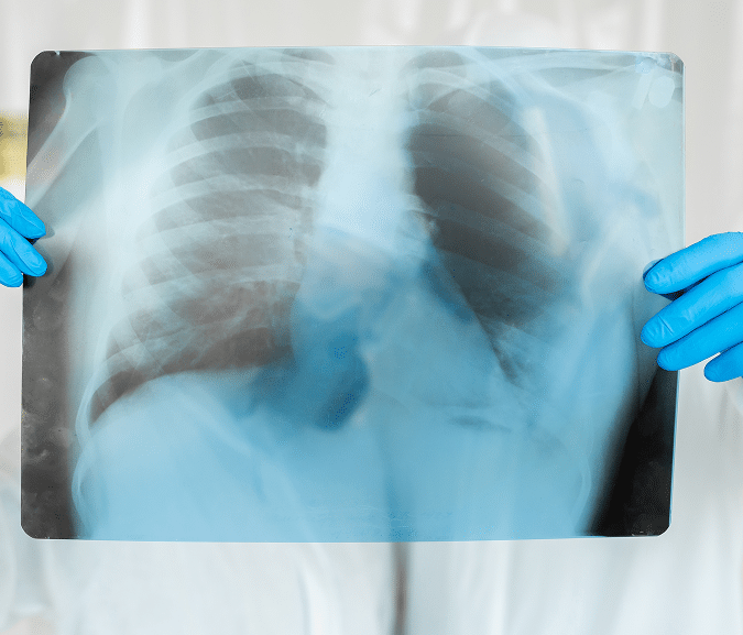 close up of a chest x-ray showing the lungs