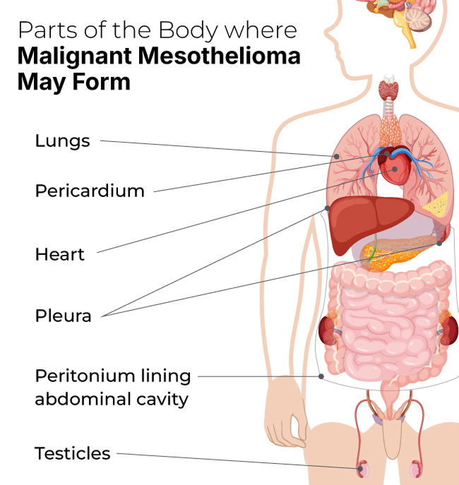Parts of the body where malignant mesothelioma form including the lungs, heart, and pleura