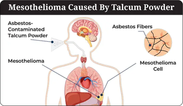 Mesothelioma caused by Talcum Powder
