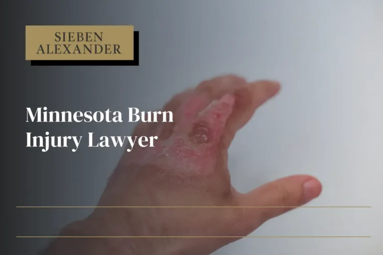 A hand with a burn injury